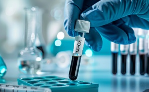 Mpox Maroc : premier cas en Afrique du Nord Mpox Maroc : premier cas en Afrique du Nord